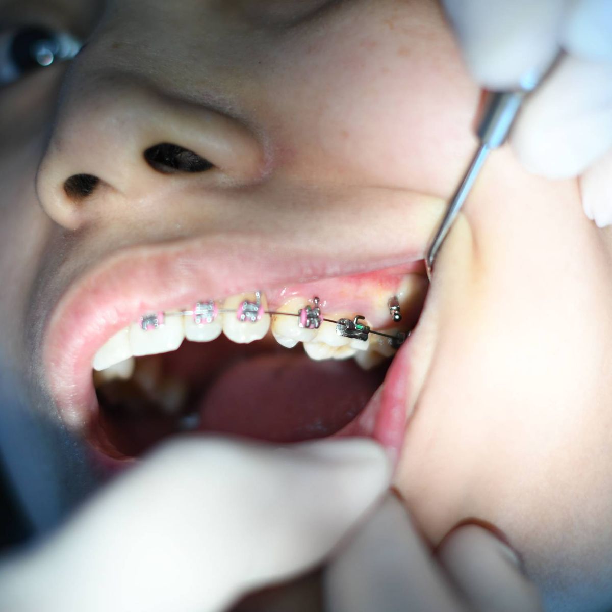 Una patente caducada dispara las ortodoncias en España (pero cuidado con  las gangas)