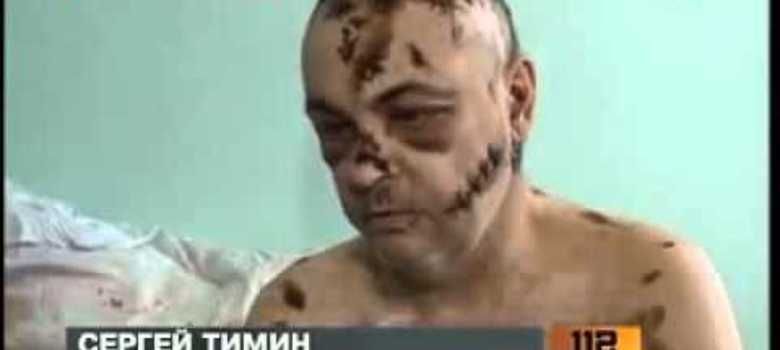 Un paciente ruso visiblemente afectado por el consumo de 'Krokodile'.
