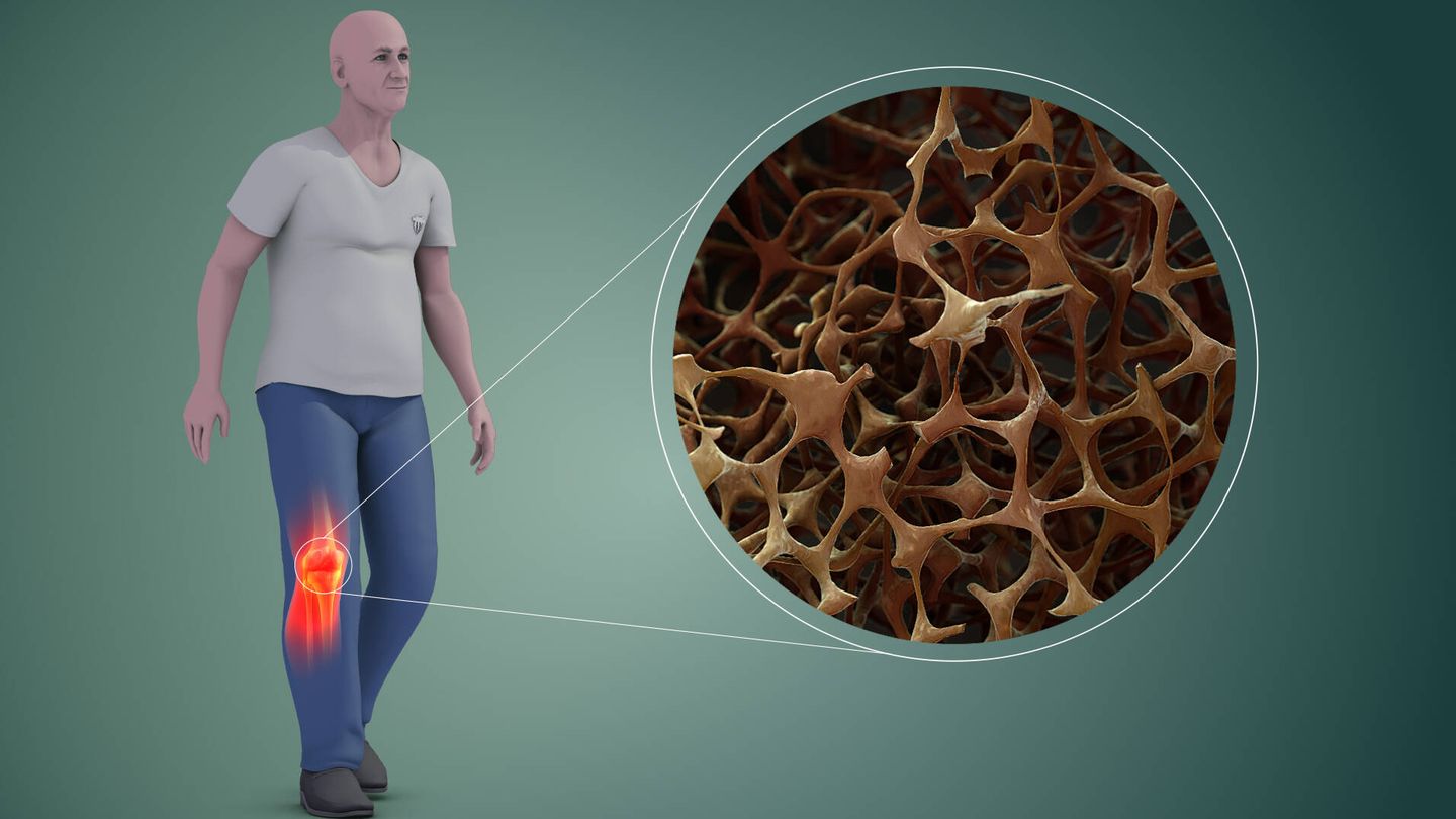 Huesos con osteoporosis. (Wikemedia Commons)