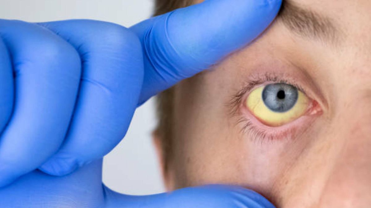 Piedras en la vesícula, malaria, anemia... Qué enfermedades pueden estar detrás de unos ojos amarillos
