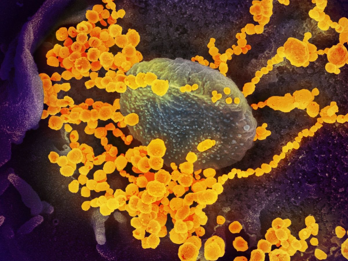 Foto: Imagen de microscopio electrónico que muestra (objetos en amarillo) al SARS-CoV-2, el virus que causa el brote del coronavirus COVID-19 (EFE)