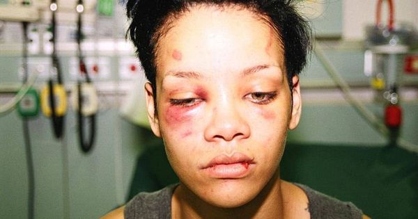 Foto: Imagen de Rihanna publicada por ella en redes sociales para denunciar la paliza que le dio Chris Brown. 