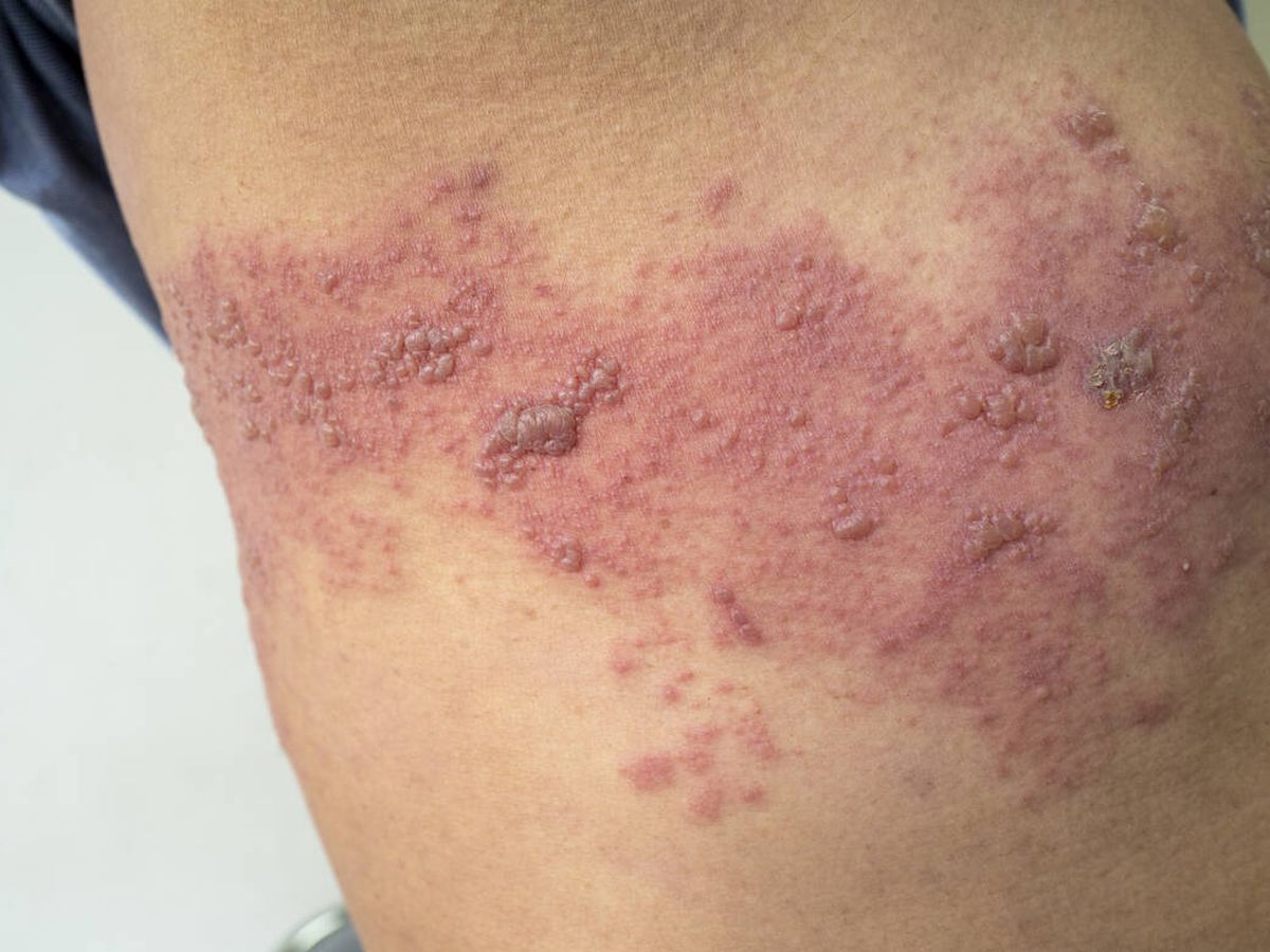Foto: El herpes zóster está causado por el virus de la varicela (Foto: iStock)