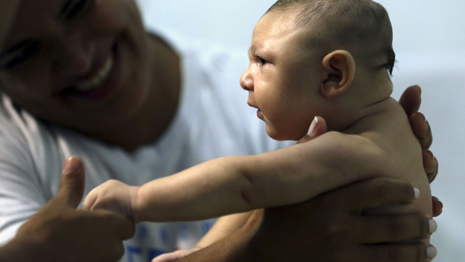 Foto: Imagen de archivo de un bebé con microcefalia. (Reuters)