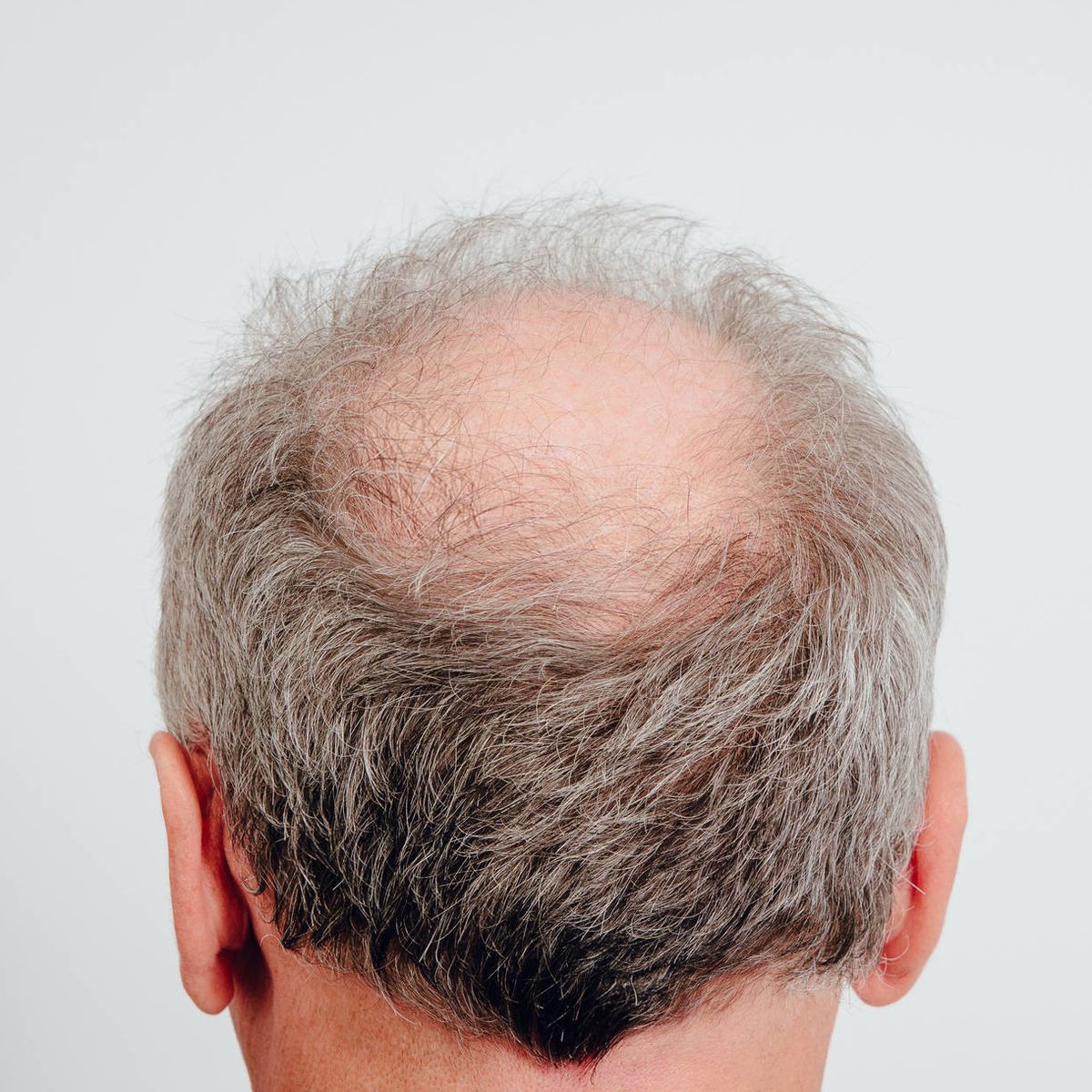 aliviar aguja estéreo Así evoluciona la caída del pelo en los hombres (y cuál es la década clave)