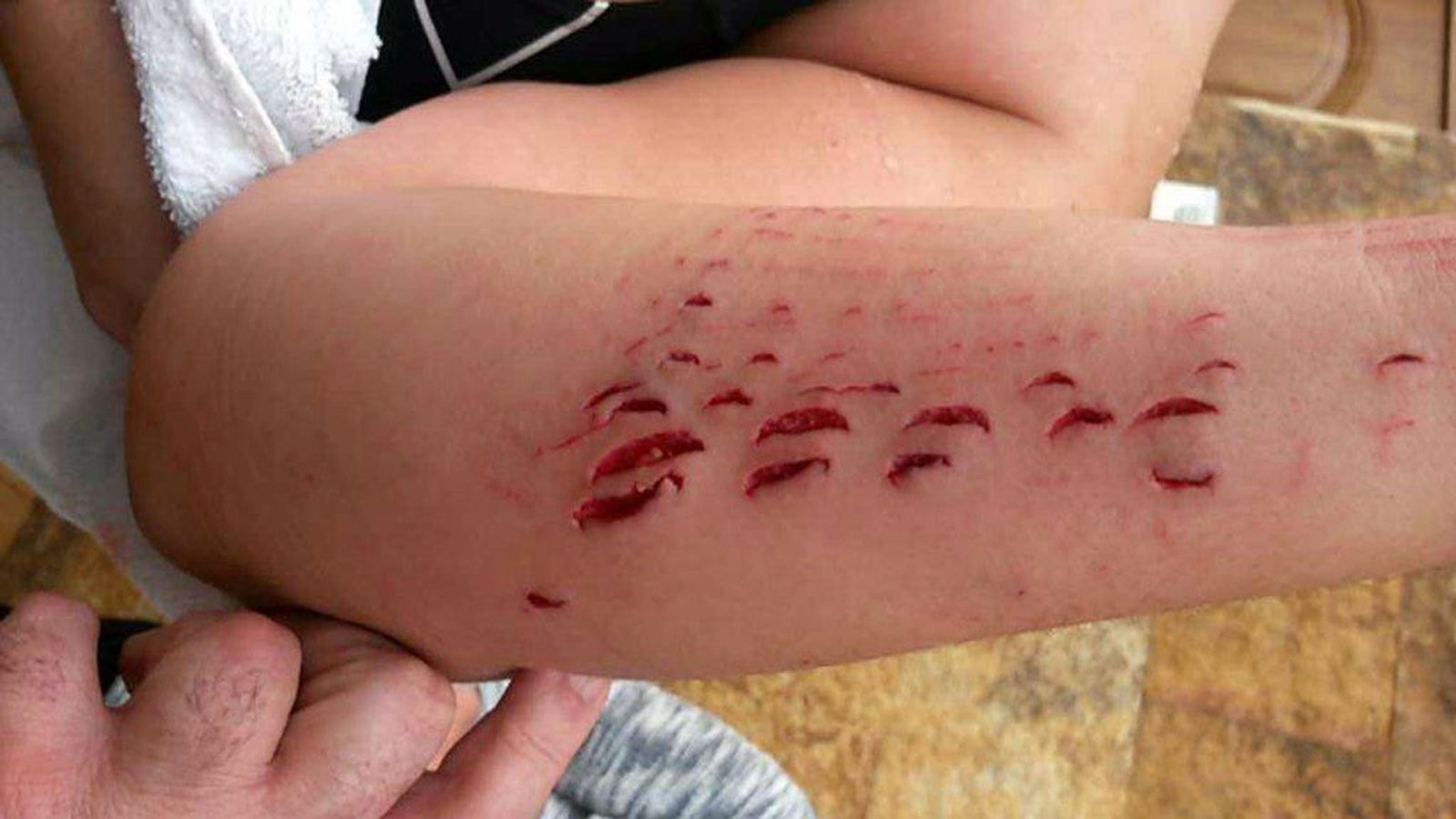 Foto: Así quedó el brazo de la mujer después de la mordida del tiburón (Twitter/@ojedathies)