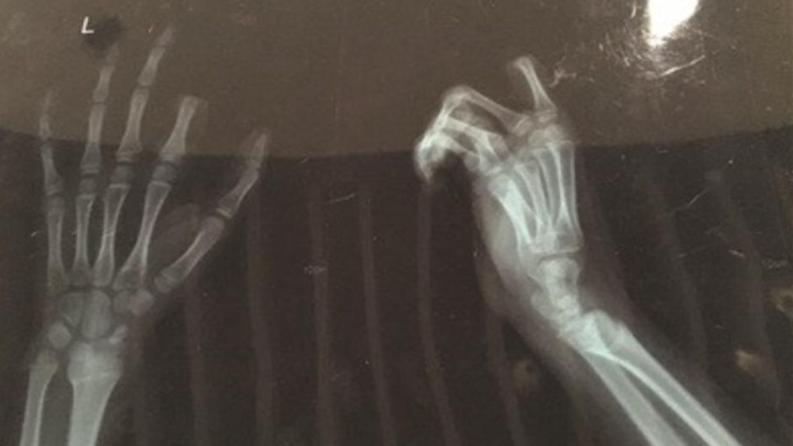 Foto: Radiografía de la mano con el dedo cortado. 