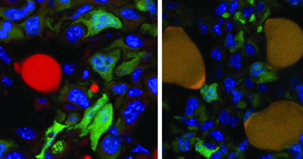 Foto: Las células tumorales (rojo) pasan a ser nódulos adiposos con el tratamiento. (Cancer Cell)