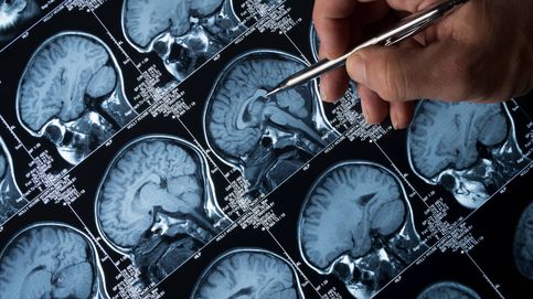 5 señales que te alertan del alzhéimer, según la Universidad de Cambridge
