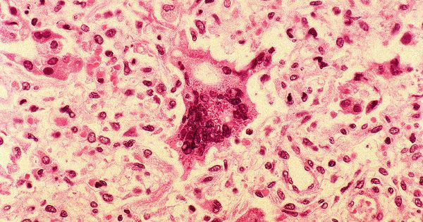 Foto: Células infectadas por el sarampión. (CDC/ Edwin P. Ewing, Jr)