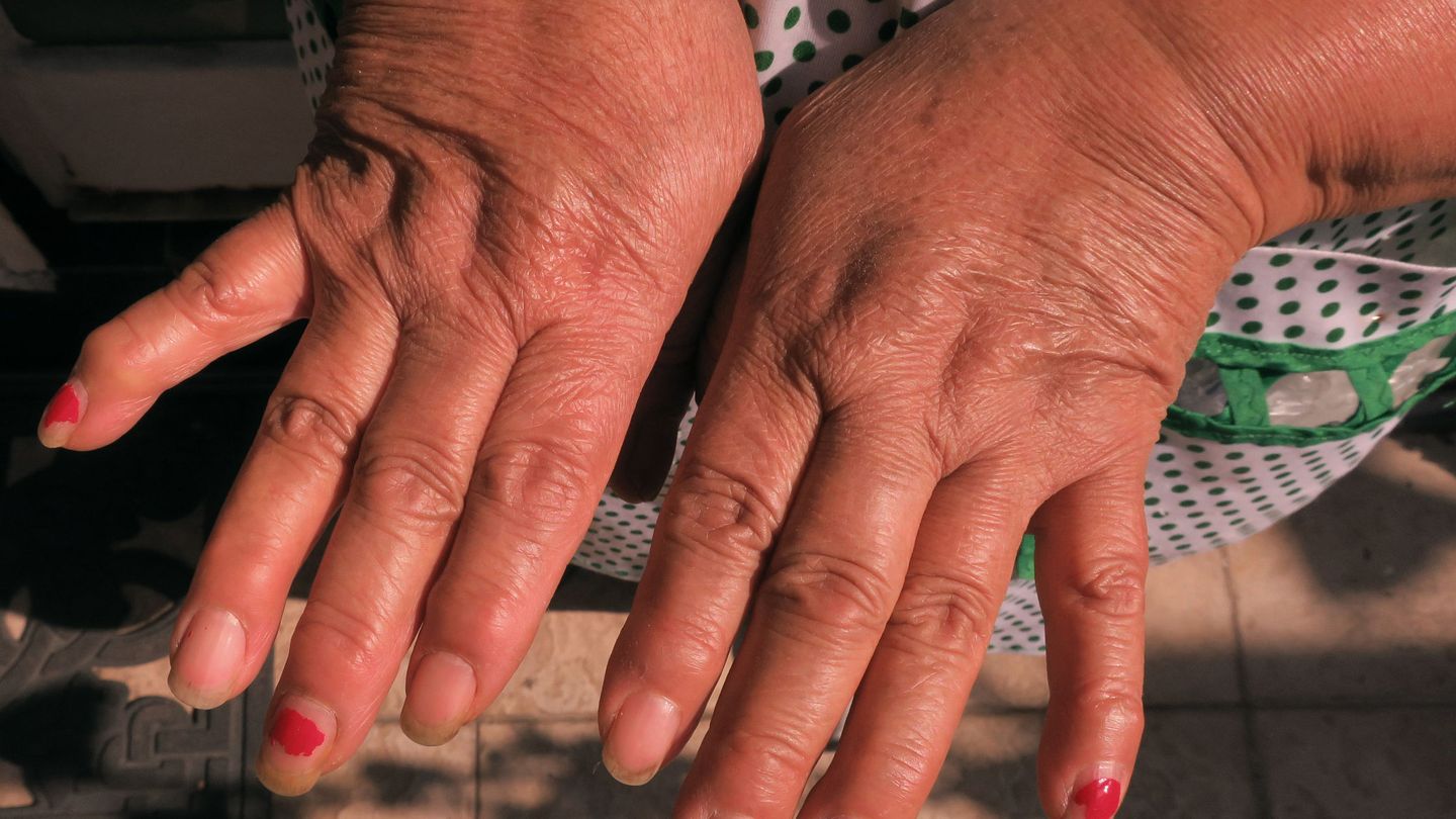 Ascensor Arco iris periódico Síntomas que no debes ignorar: no lo sabes, pero tienes artritis