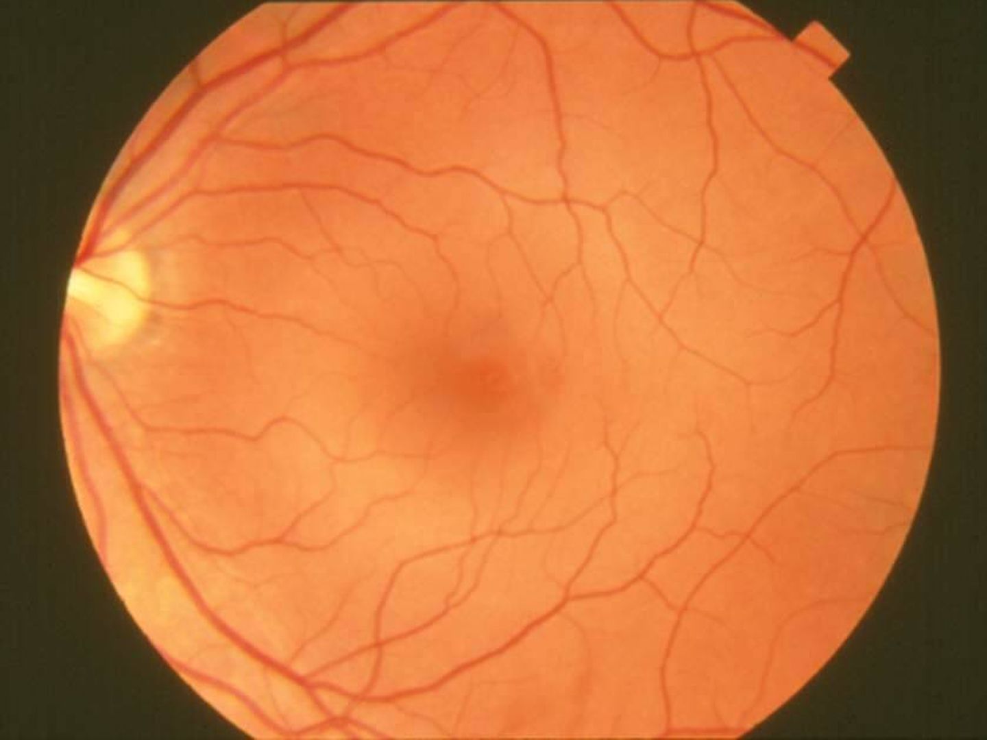 Los investigadores han utilizado la IA para descubrir la edad retiniana. (Wikipedia)