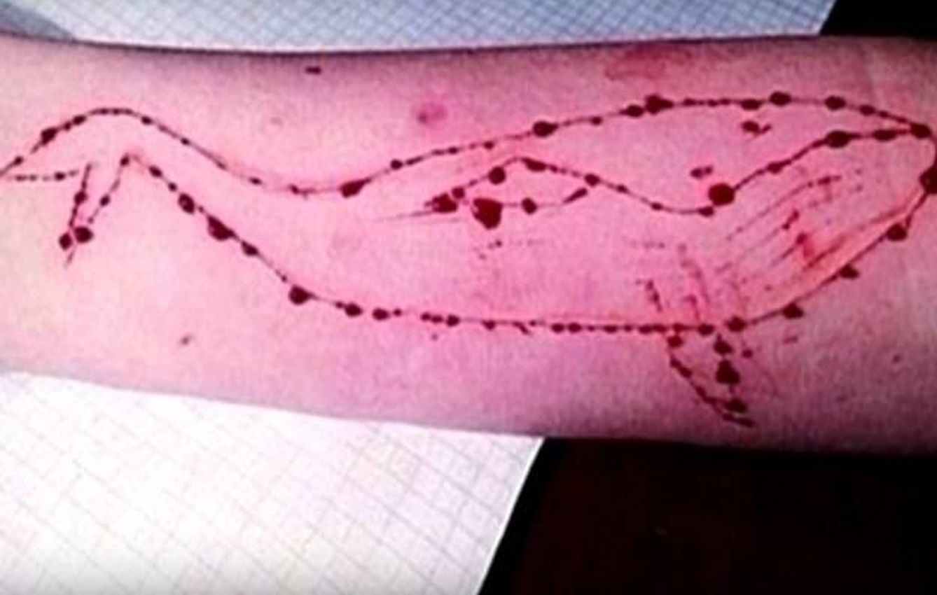 Foto del brazo de uno de los adolescentes autolesionados en Siberia. (Fuente: 'The Siberian Times')
