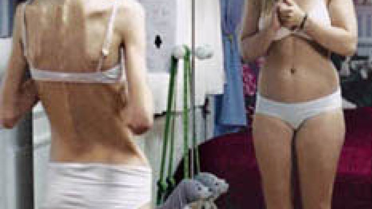 Una educación hiperprotectora influye en el desarrollo de la anorexia