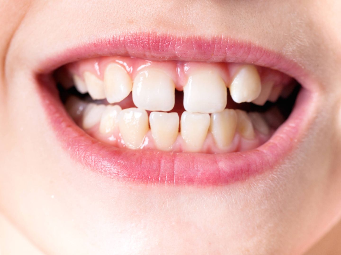 Las claves del bruxismo: síntomas y causas por las que rechinas los dientes  por la noche
