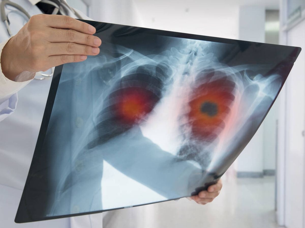 Foto: El cáncer de pulmón es el que acumula mayor número de fallecimientos. (iStock)
