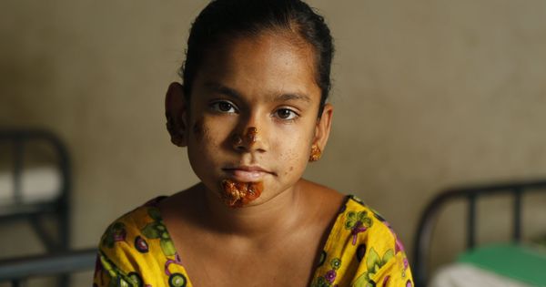 Foto: Shahana Khatun, una niña de 10 años de Bangladesh que sufre el síndrome del hombre árbol (Reuters)