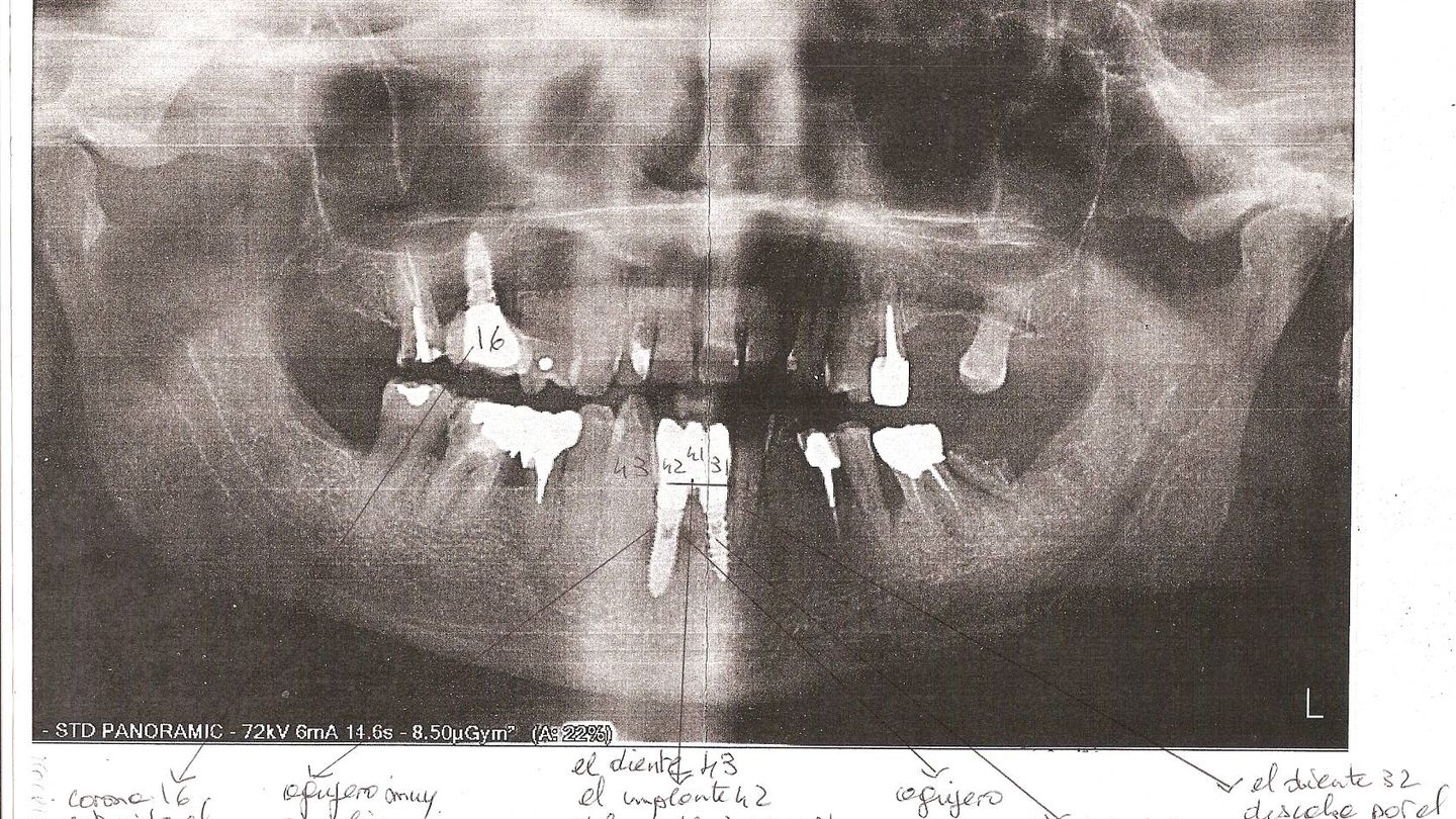 Radiografía panorámica de Michel Guillien tomada en su segunda visita.