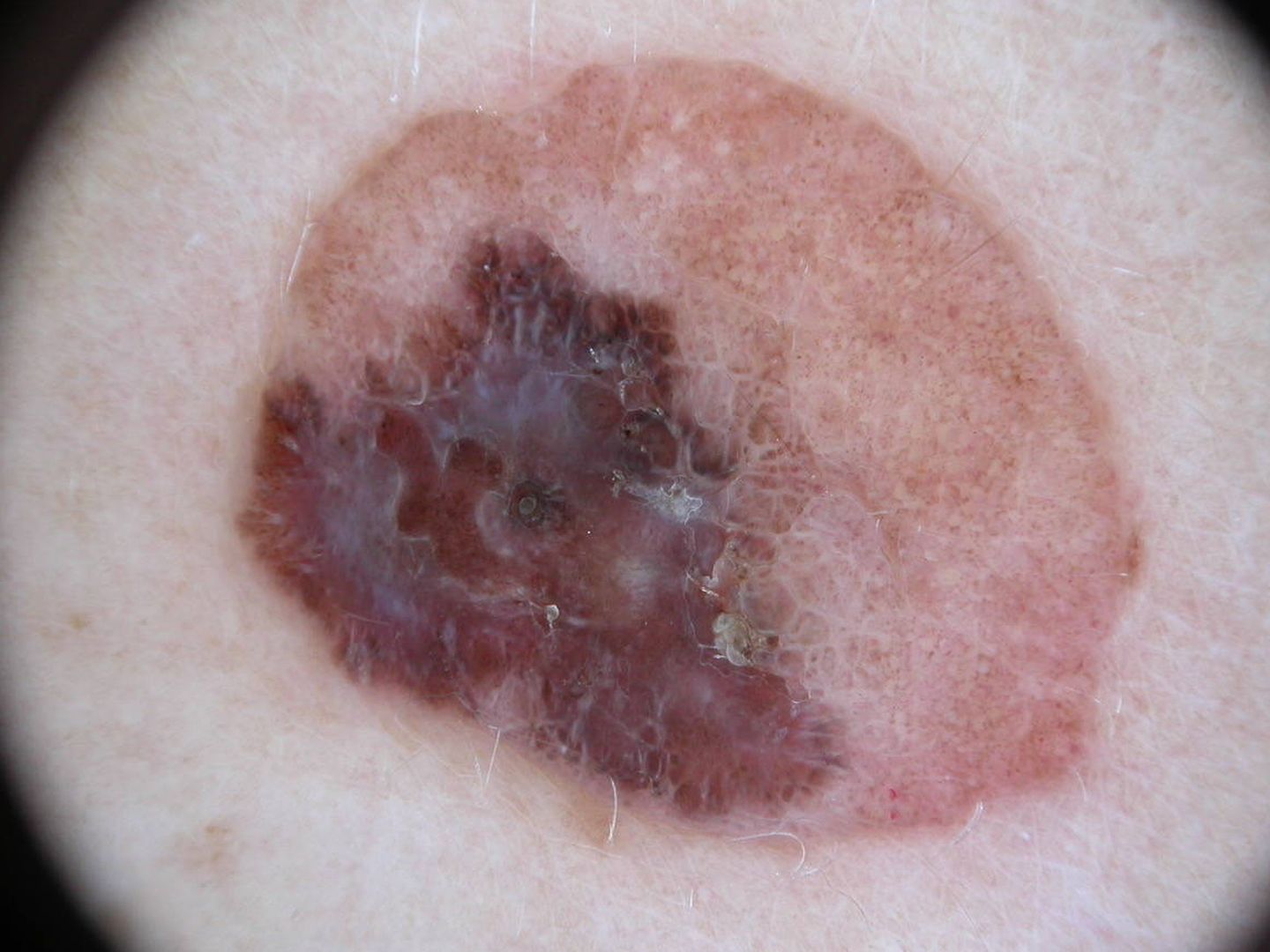 Imagen de un melanoma proporcionada por Silvestre Martín.