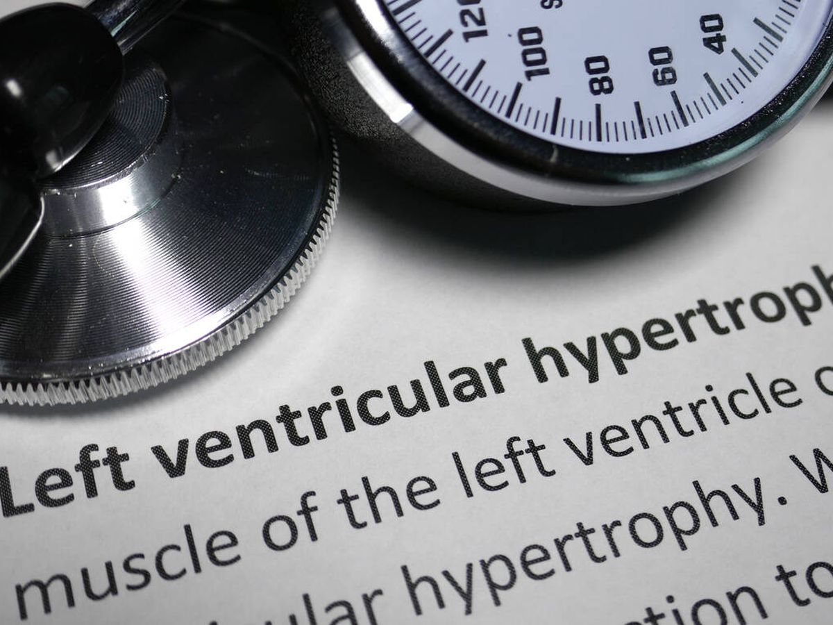 Foto: La hipertrofia ventricular izquierda es una patología cardiaca muy prevalente. (iStock)