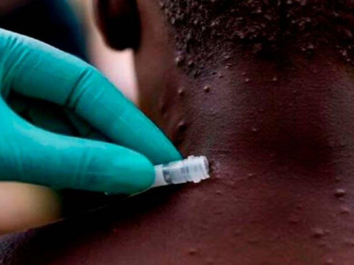 Foto: Un médico toma muestras de la piel de un niño. (YouTube)