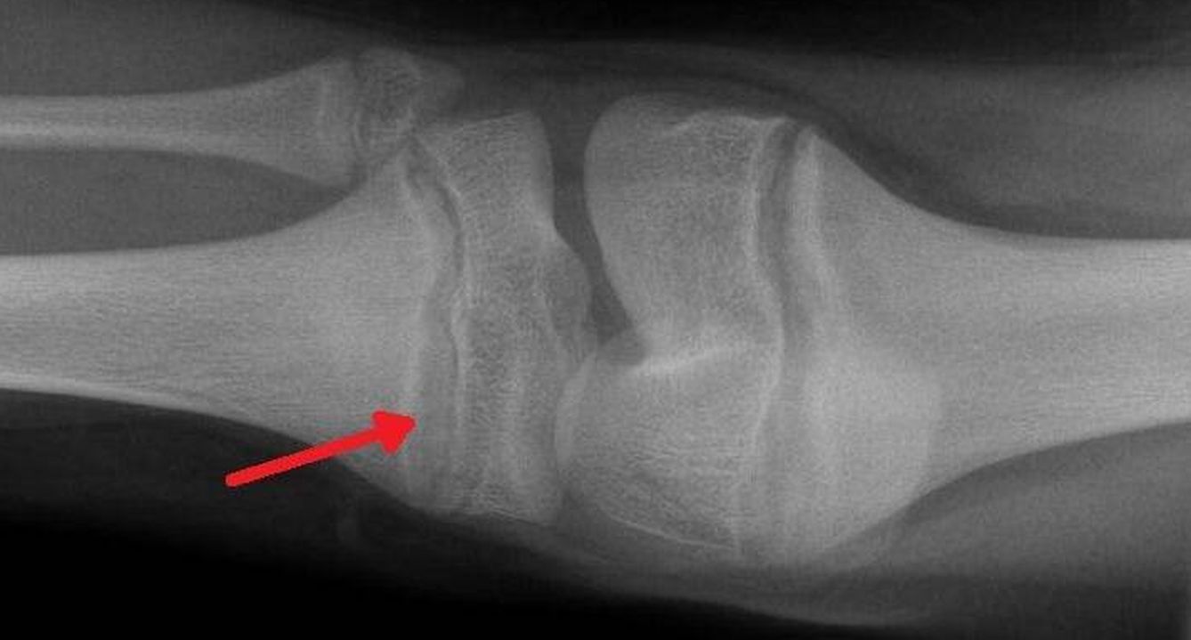 Acumulación de plomo en una rodilla vista en una radiografía.