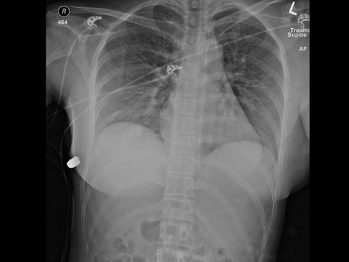Foto: Radiografía de la mujer después del disparo, donde se puede apreciar la bala retenida por el implante. (Plastic Surgery Case Studies)