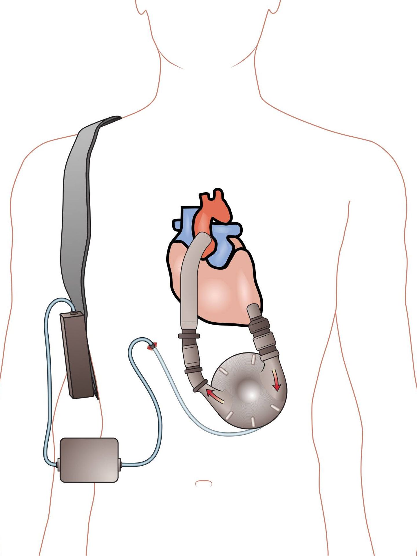 Un dispositivo de asistencia ventricular.