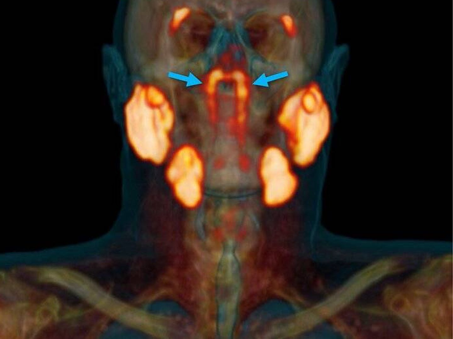 Señaladas con una flecha azul, las glándulas salivales recién descubiertas. Foto: (The Netherlands Cancer Institute