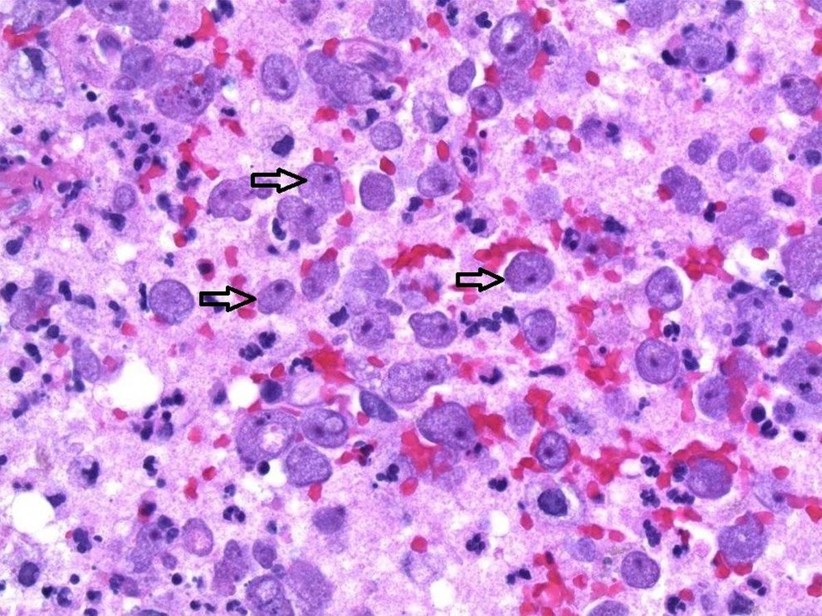 Foto: Sólo cuando pasaron los tejidos por el microscopio detectaron las amebas (Foto: Swedish Medical Center)