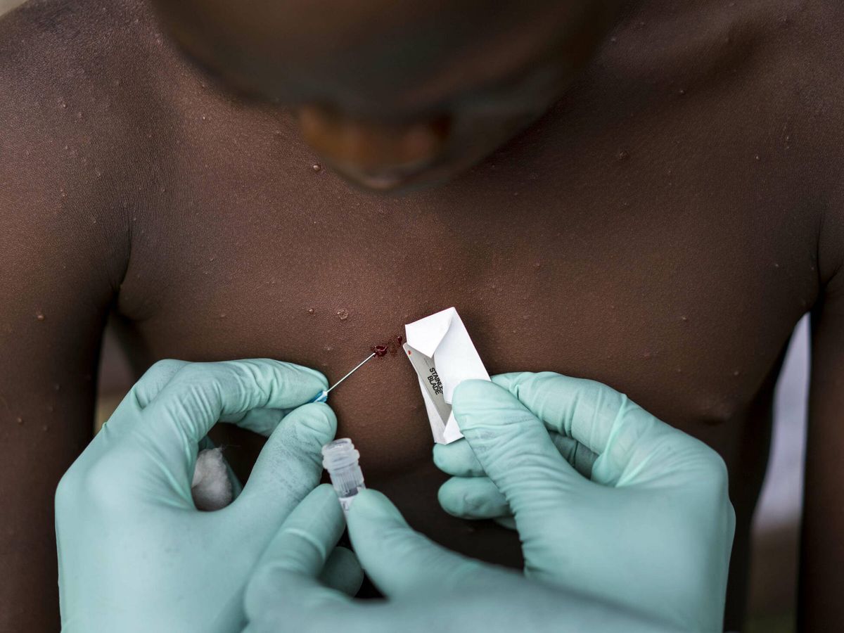 Foto: Un médico congoleño toma muestras de la piel de un niño, sospechoso de tener el virus del mono. (Getty Images/Melina Mara)