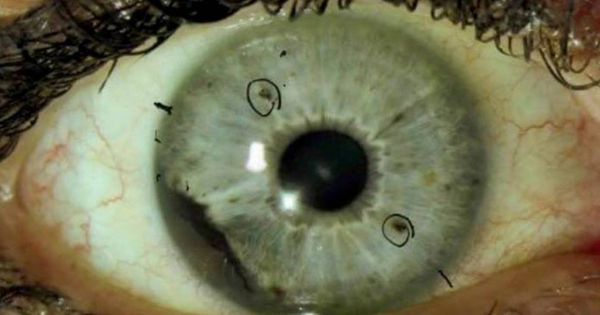 Foto: Melanoma ocular. (Universidad de Auburn)