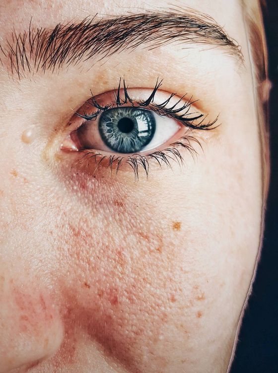 La piel irritada y descamada es consecuencia del mal uso del retinol.  (Pexels/Almada Studio)