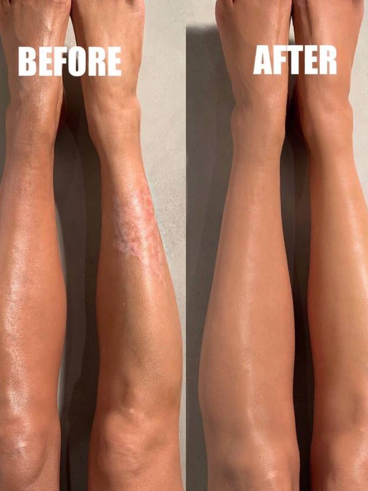 Las piernas de Kim Kardashian con manchas de psoriasis, antes y después de su maquillaje. (KKWBeauty)