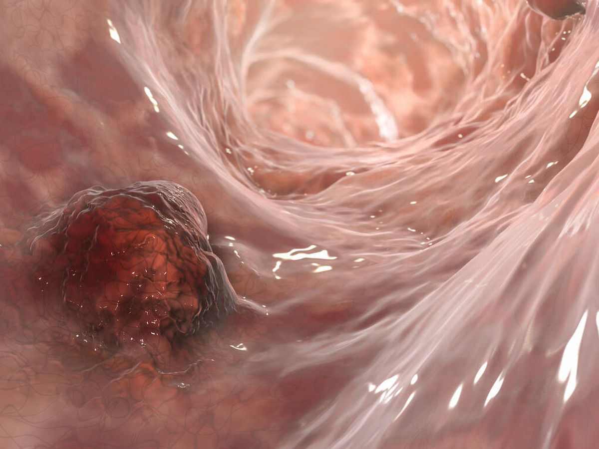 Foto: Ilustración de cáncer de colon. (iStock)
