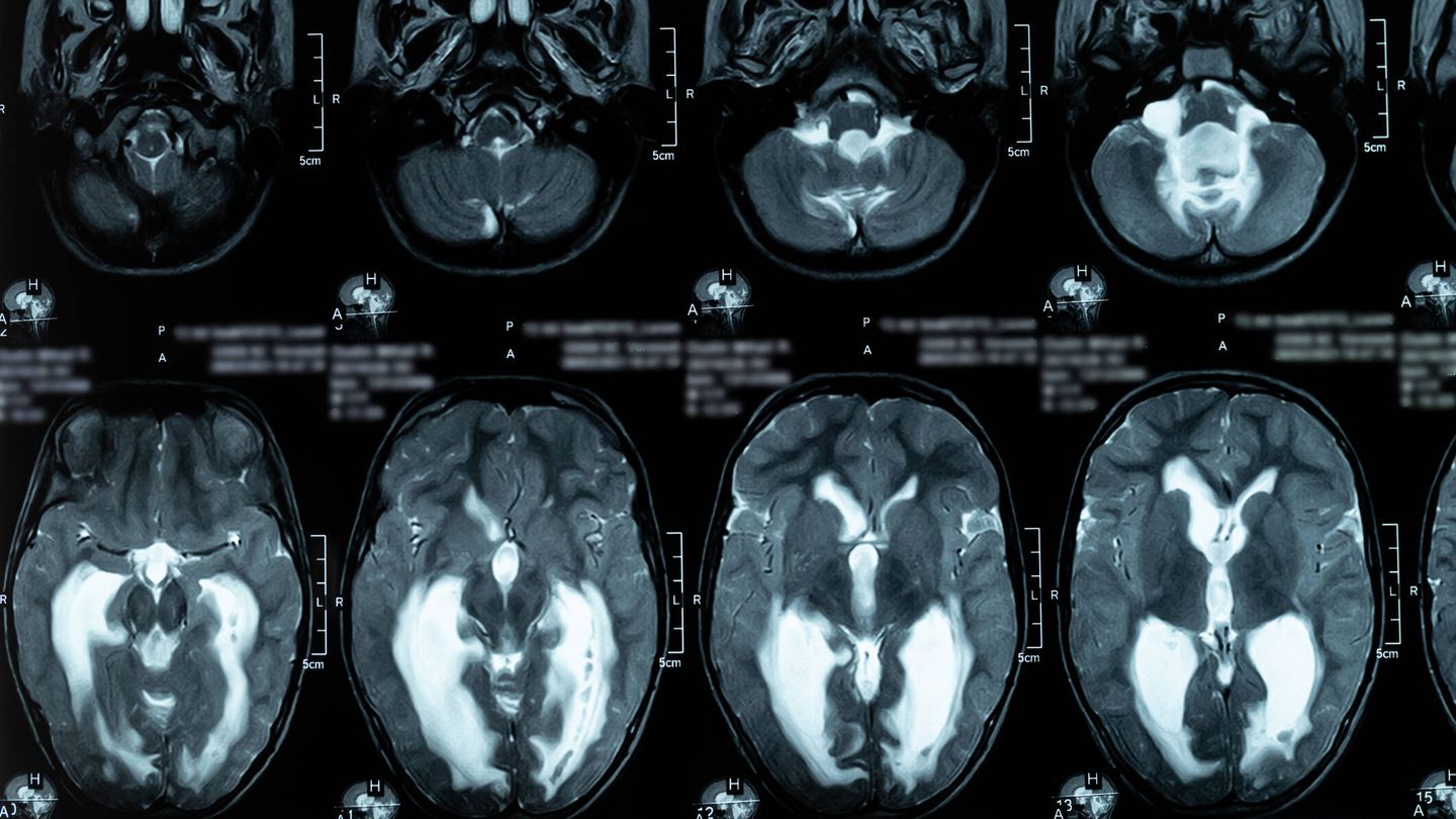 Resonancia magnética del cerebro. (iStock)