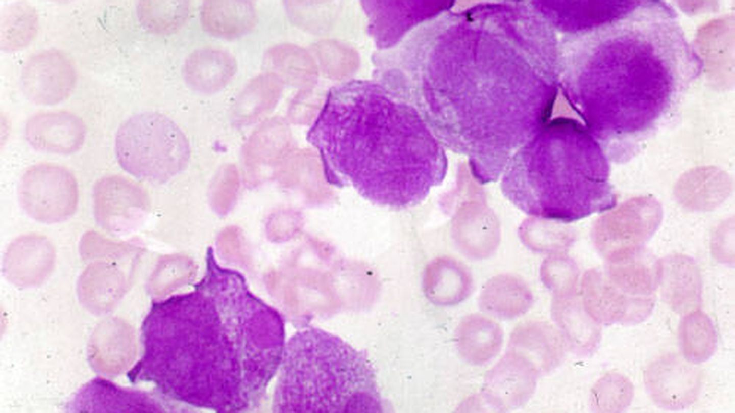 Leucemia mieloide aguda. (HildeErling/Wikimedia)