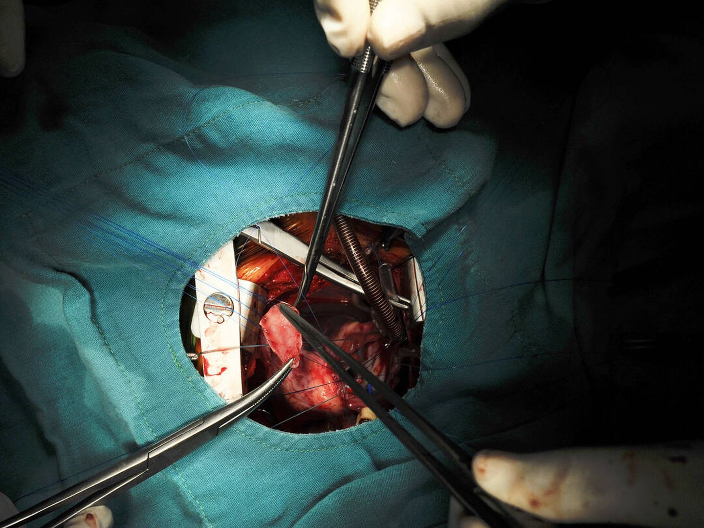 Cirugía cardiaca pediátrica (iStock)