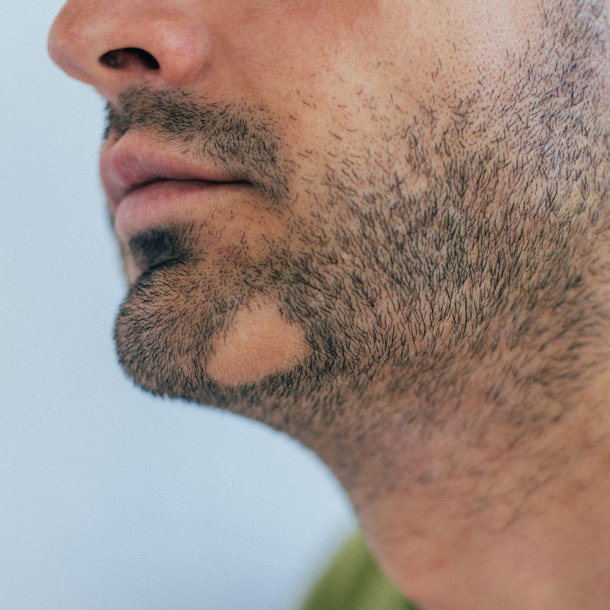 areata: duración solución de las calvas en barba