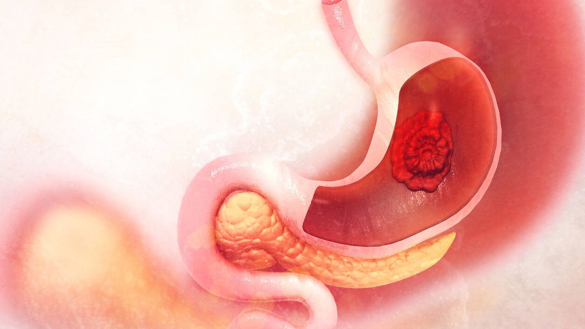 Guía completa del cáncer de estómago: síntomas, tratamientos, tipos, avances y cirugías