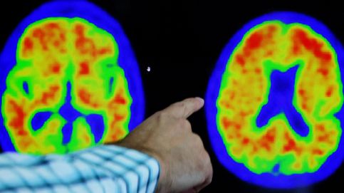 Un estudio demuestra que la región de la amígdala cerebral es clave en el alzhéimer