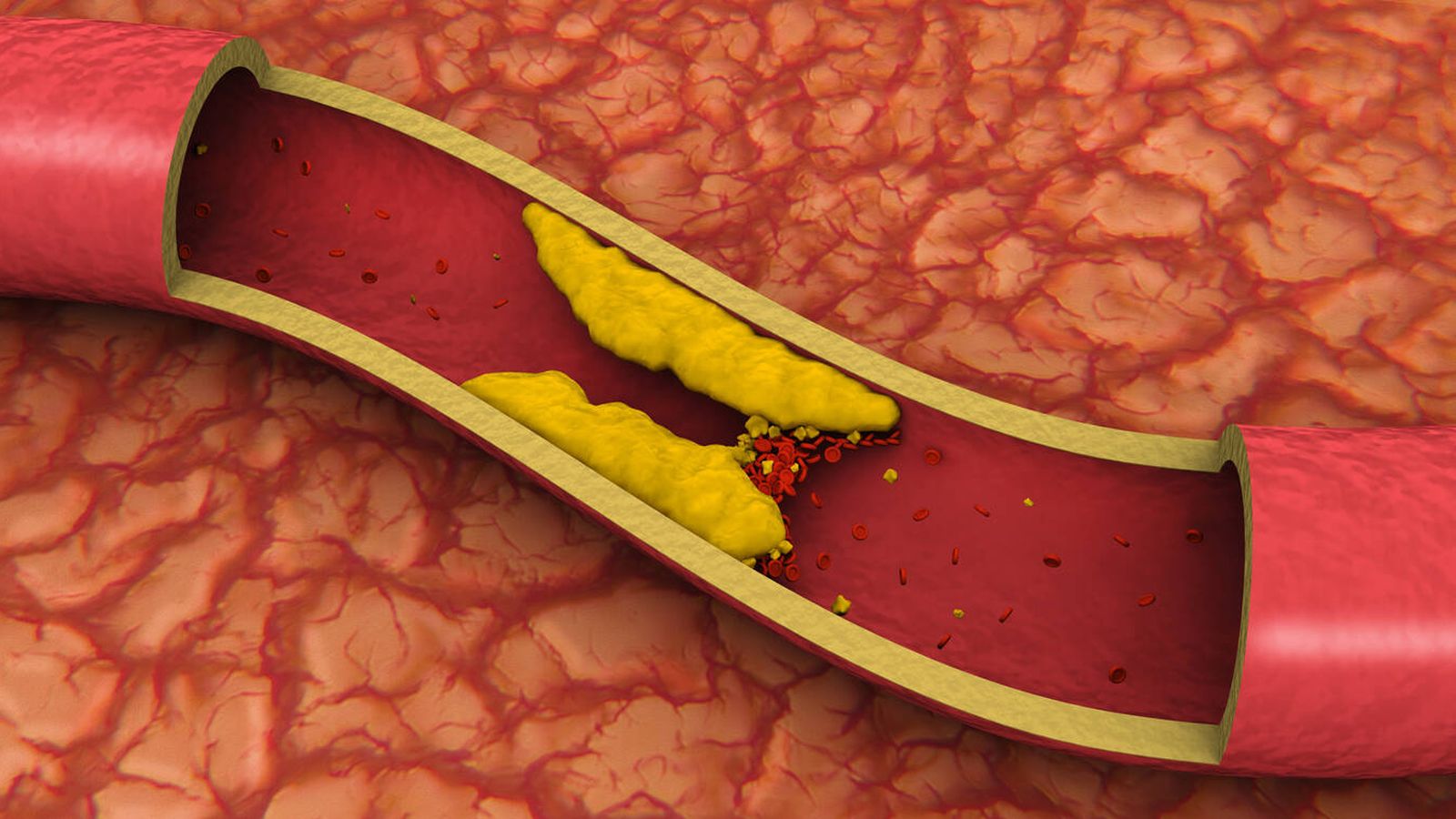 Ilustración de un vaso sanguíneo. (iStock)