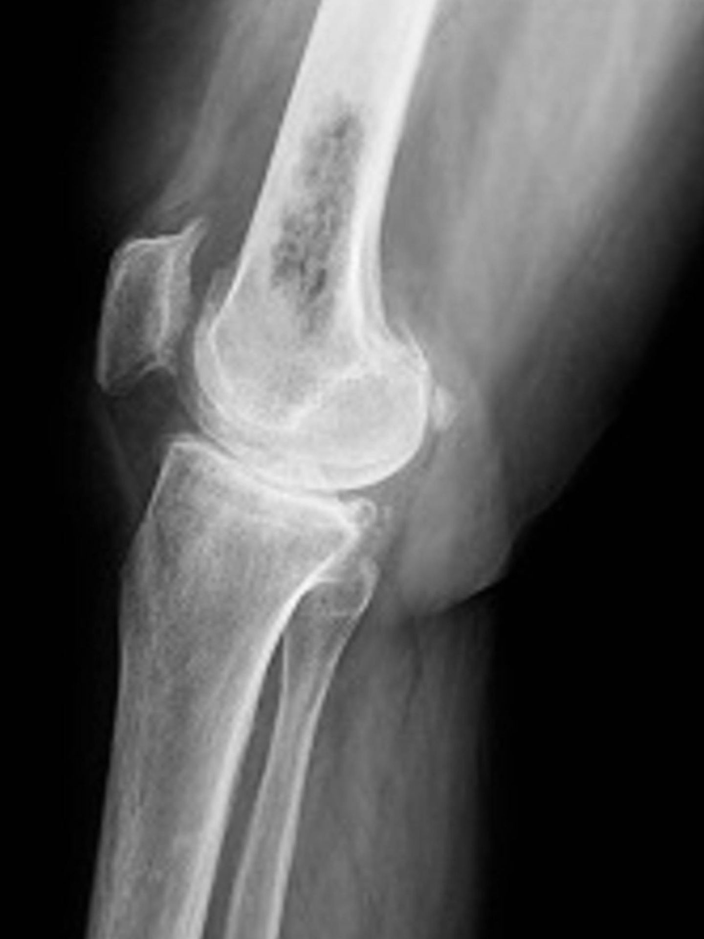 Una radiografía donde se ve una rodilla con osteosarcoma. (MedlinePlus)