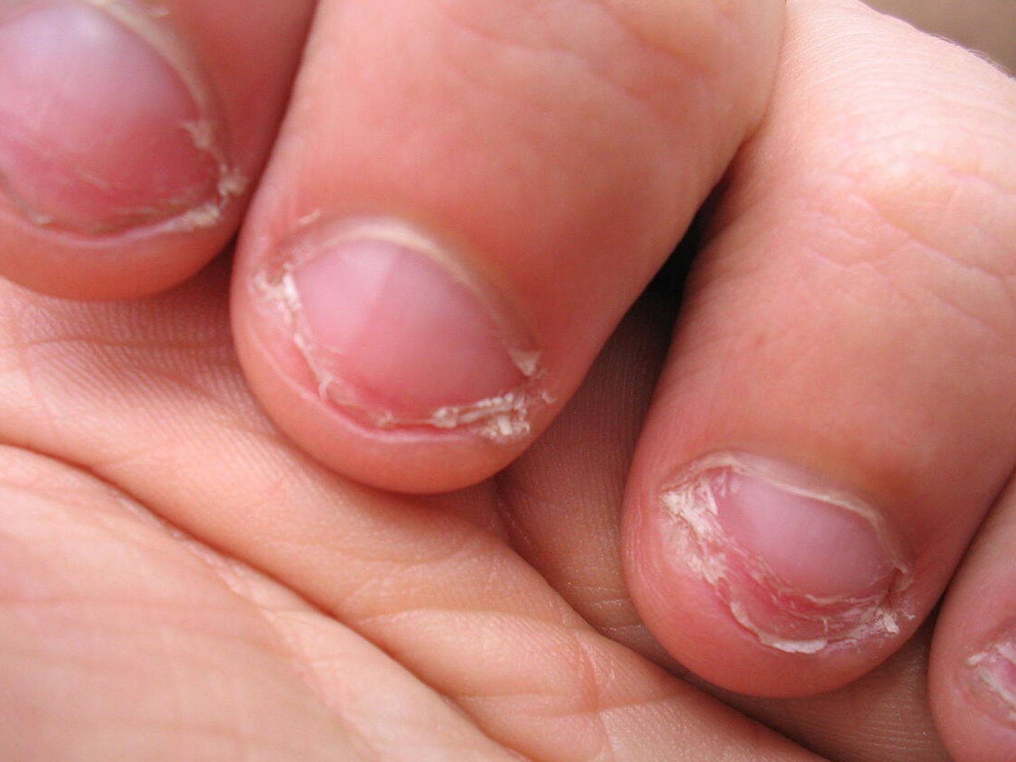 Morderse las uñas acaba deformando los dedos y las cutículas (Wikipedia/José Carlos Pace)