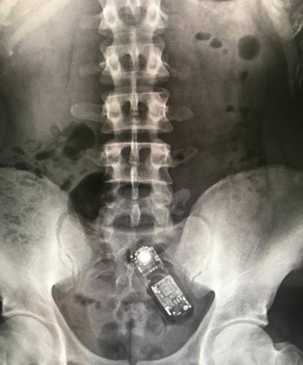 Foto: Teléfono que una persona trató de introducir en su organismo. (EC)