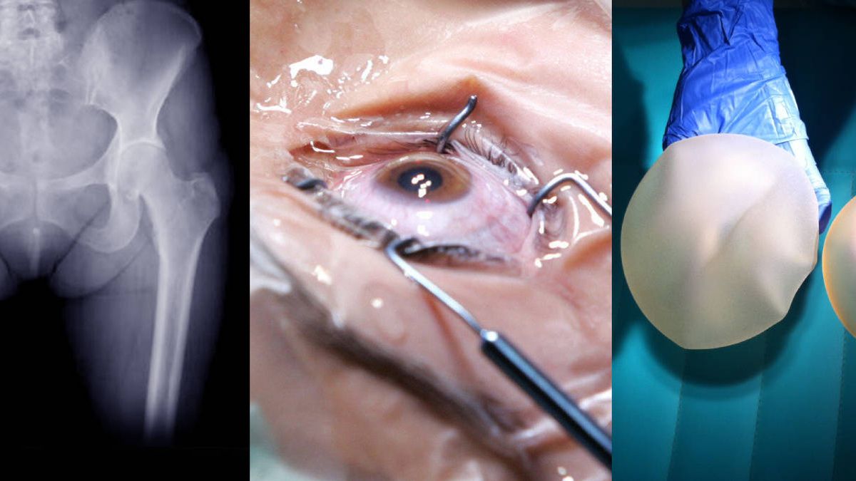 El colegio de médicos se defiende tras los Implant Files: "cumplen las garantías"