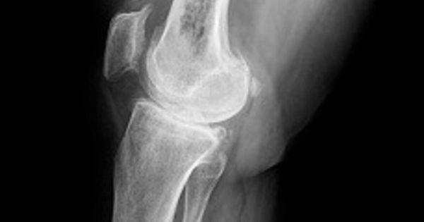 Foto: Una radiografía donde se ve una rodilla con osteosarcoma (MedlinePlus)
