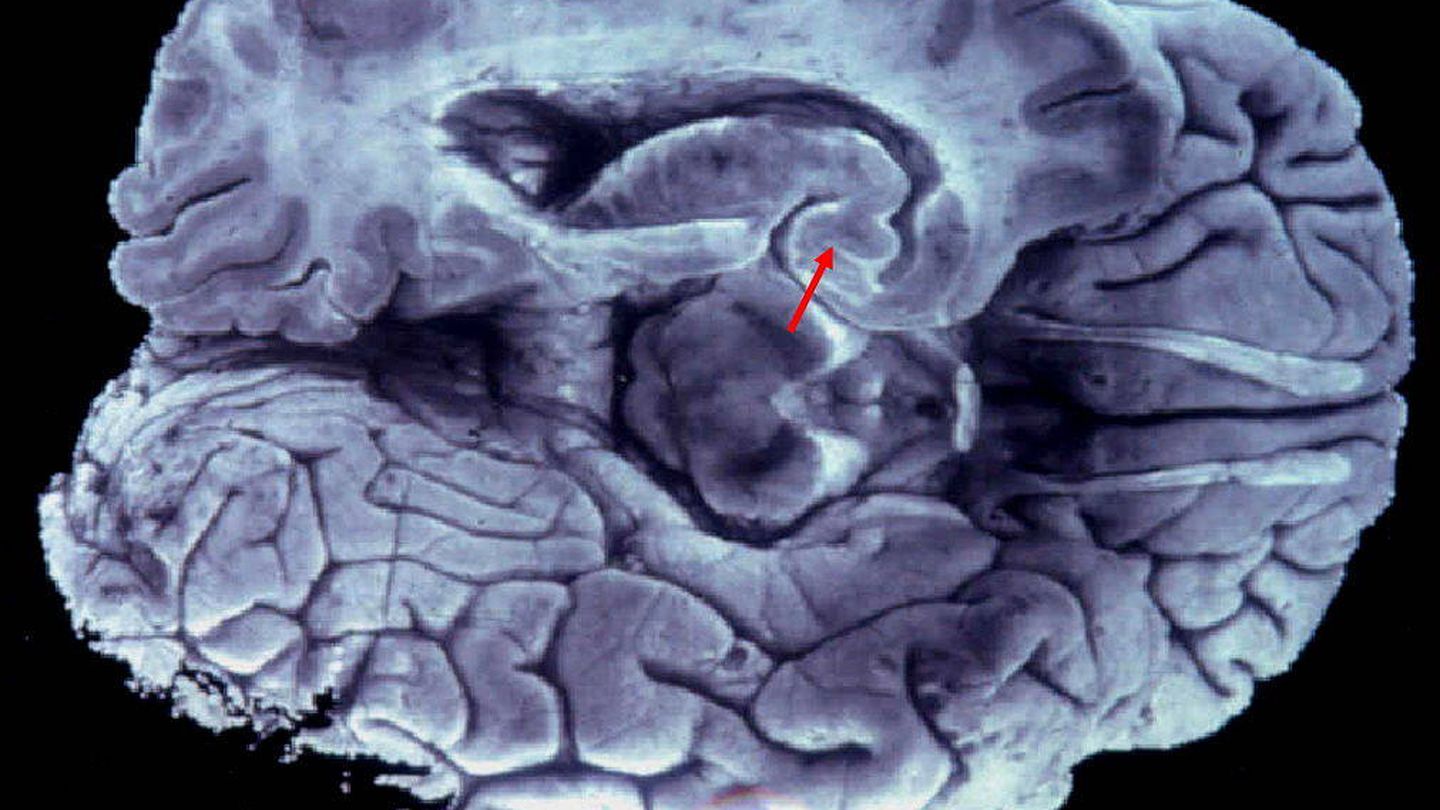 Detalle de un cerebro de un banco de tejidos neurológicos. (EFE)