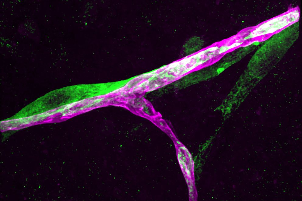 Una célula cancerígena (morado) se abraza a un vaso capilar (verde). (MSKCC) 