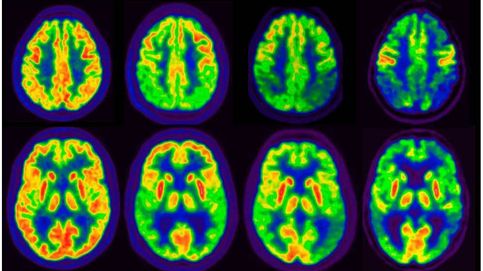Revierten la pérdida de memoria del Alzheimer mediante una terapia génica